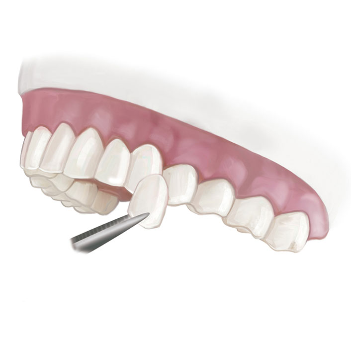 Veneers - Dental Services